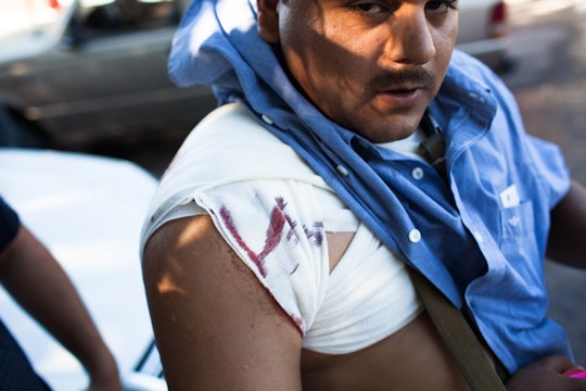 "El Gordo" (The Fatso- real name not given) a member of H3, shows off a bullet wound in La Ruana, Michoacán, Mexico, December 17, 2014.<br /><br /> El Gordo was hurt in a confrontation between two rival vignette groups, including H3 and one led by Mora. The conflict left eleven people dead.