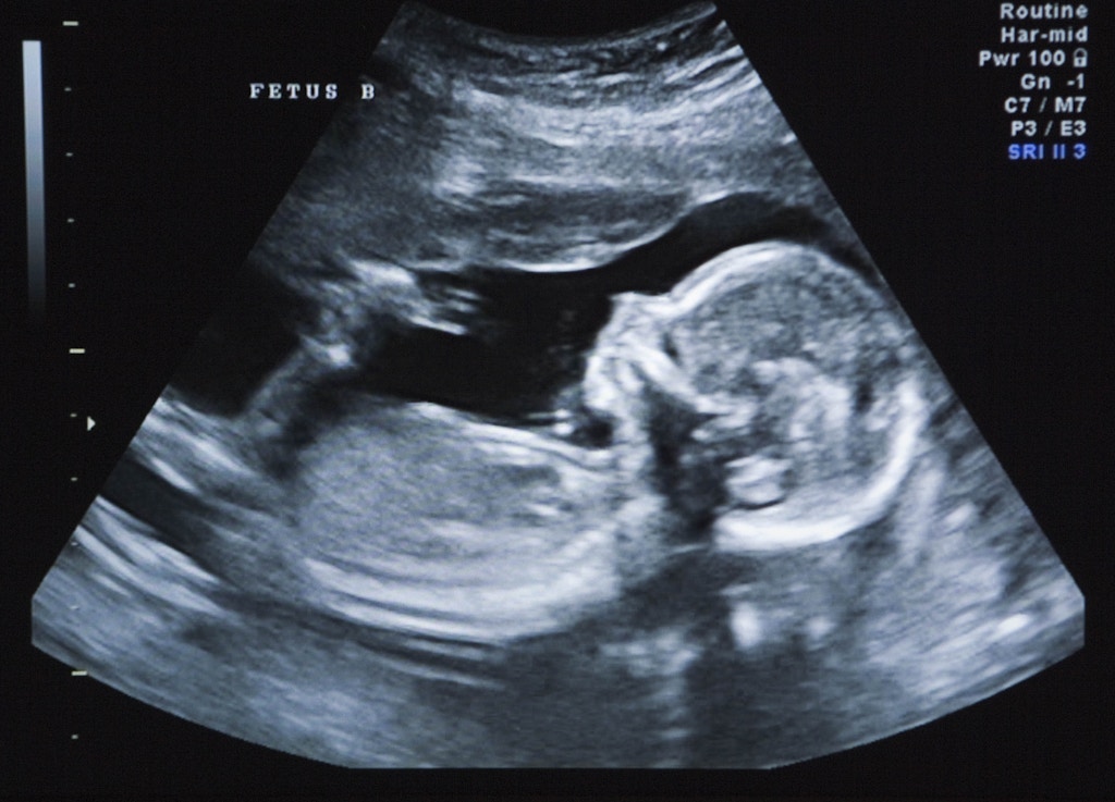 Ultra-Sound of Identical Twin