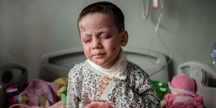 Awra Ali, 4, sits in her hospital bed at West Erbil Emergency in Erbil, Iraq on March 30, 2017.