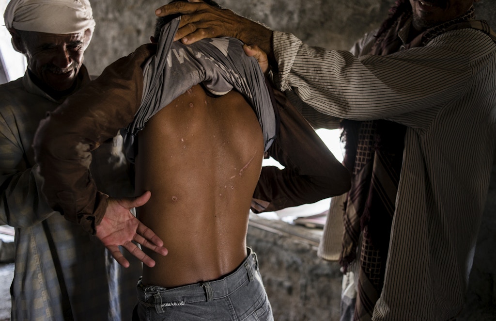 Yemeni men show off the scars from fragmentation injuries on a young man from the village on May 6, 2018 in al Ragha Village, Bani Qais District, Hajjah, Yemen.