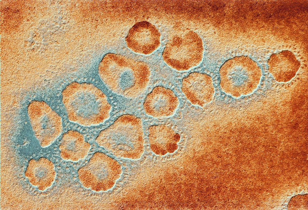 Corona viruses. Coloured transmission electron micrograph of a section through a cluster of corona viruses. The corona viruses cause the common cold, gastroenteritis, pneumonia and acute renal failure in humans. The corona virus received its name because of its characteristic 'setting sun' appearance. This is provided by the projections (peplomers) studding the outer membrane of the virus. Beneath the outer membrane of each virus is the protein shell called the capsid. This encloses the nucleoprotein (genetic material)