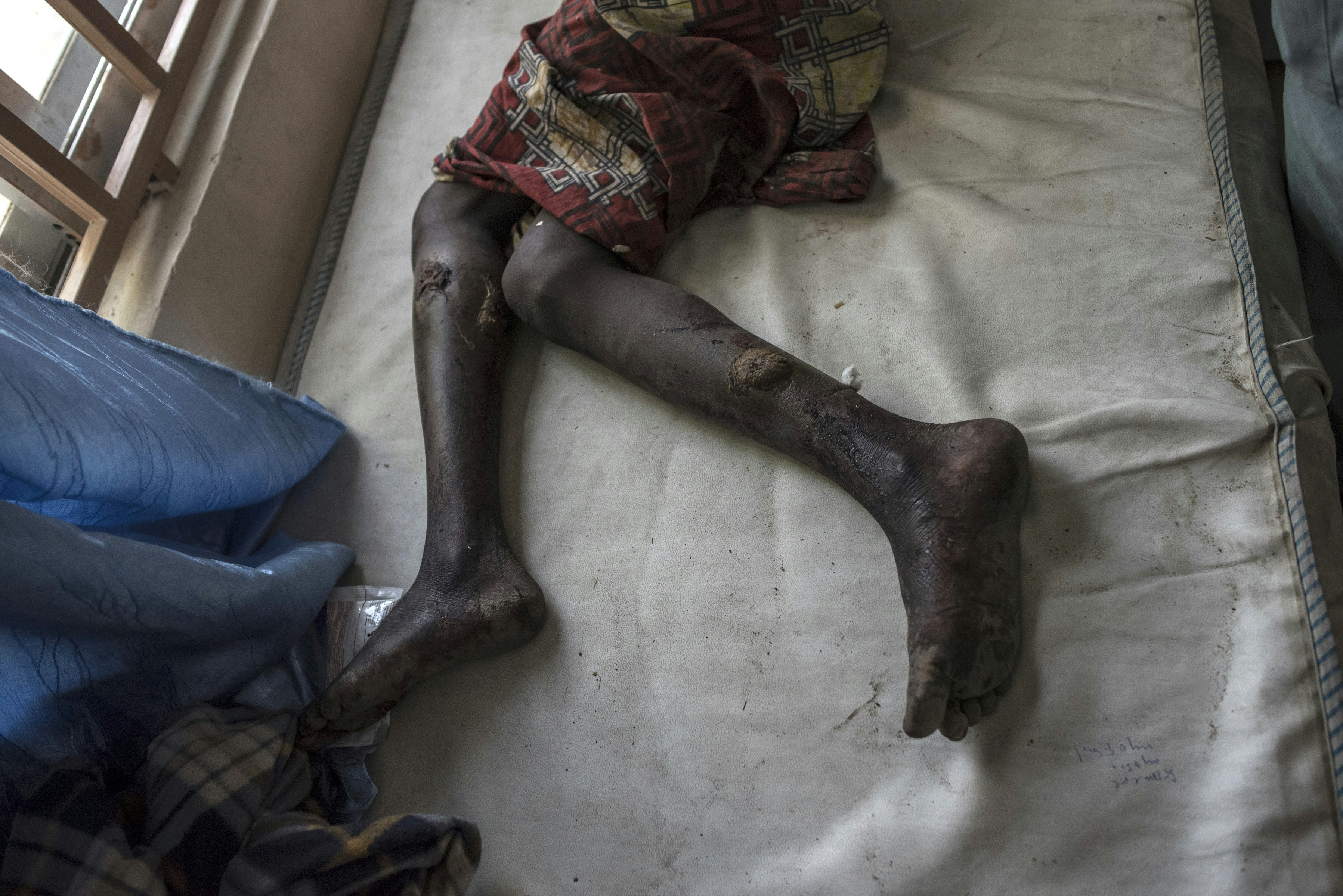 A wounded girl lies on a hospital bed at the Maiduguri State Specialist Hospital on January 18, 2017.At least 70 people have died in an IDP camp in Borno State from an accidental military airstrike on January 17, 2017, intended to target Boko Haram militants in Rann, in north-eastern Nigeria. / AFP / STEFAN HEUNIS (Photo credit should read STEFAN HEUNIS/AFP via Getty Images)